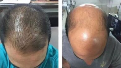 عيوب زراعة الشعر,كم تستغرق عملية زراعة الشعر,هل زراعة الشعر حرام,زراعة الشعر للنساء,شروط زراعة الشعر,تكلفة زراعة الشعر,بديل زراعة الشعر,تجربتي مع زراعة الشعر