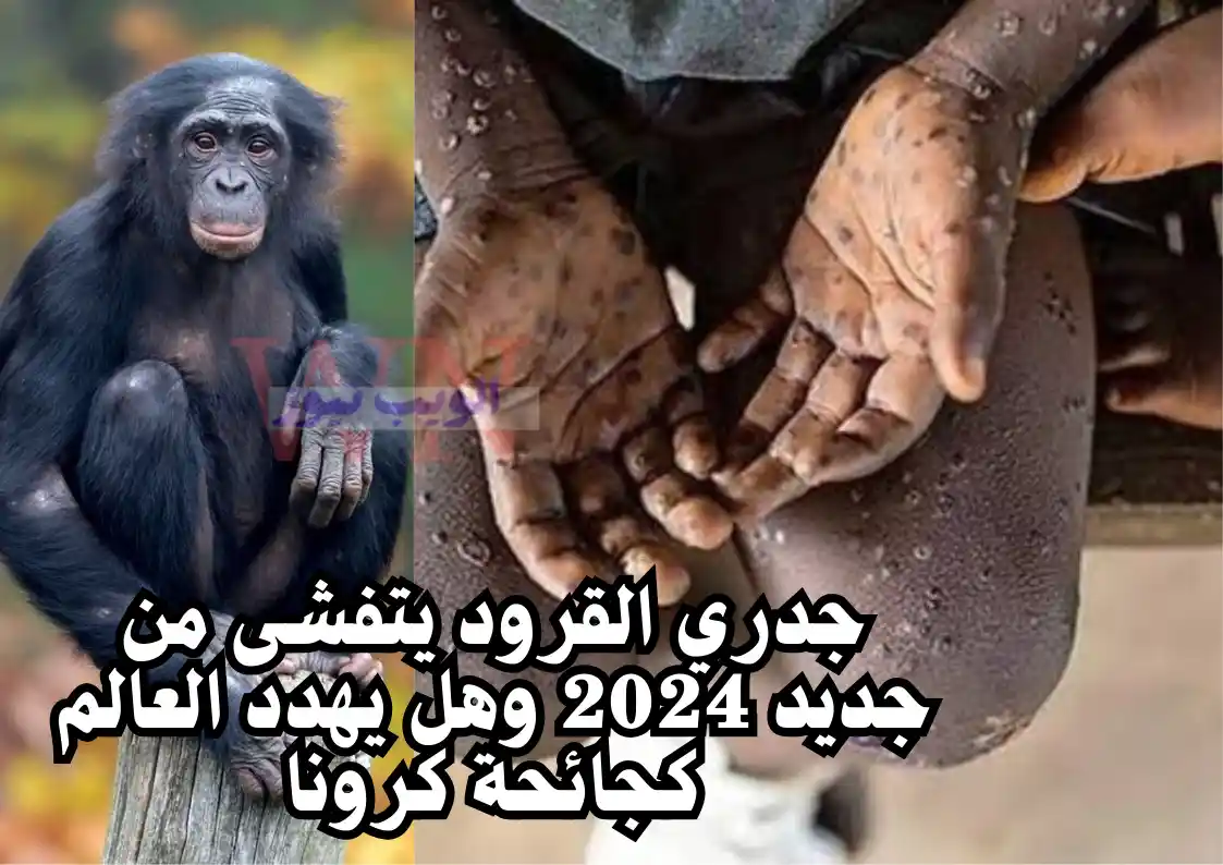 جدري القرود يتفشى من جديد 2024 وهل يهدد العالم كجائحة كرونا